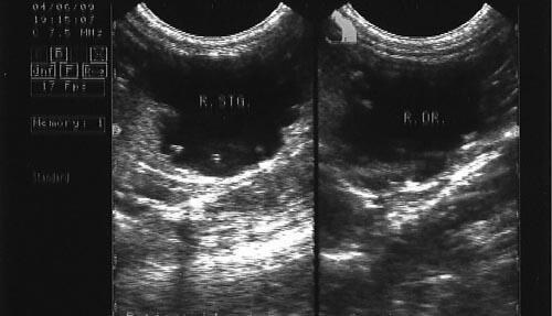 Complicatii ale interventiilor chirurgicale pe aparatul genital 