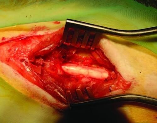 Displazie cervicala 3 grade tratament in oncologie pre?