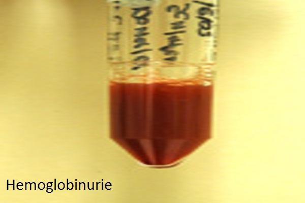 hemoglobinuria
