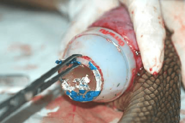 Figure 5 Complete healing of the incision line at one month after surgery
